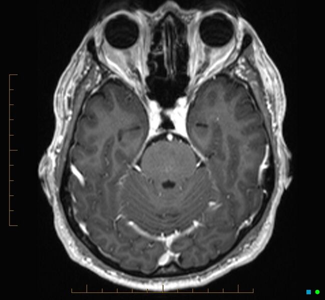 File:Cerebellar gangliocytoma (Radiopaedia 65377-74422 Axial T1 C+ 38).jpg
