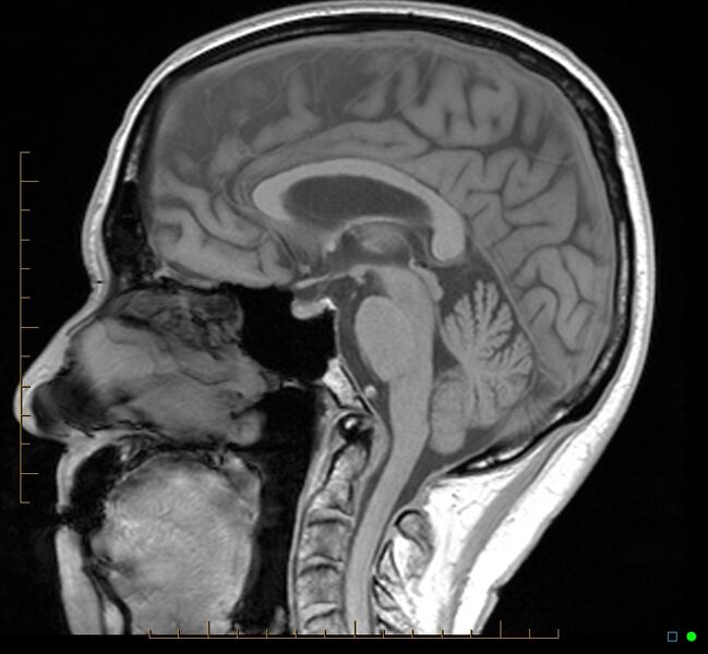 File:Cerebellar gangliocytoma (Radiopaedia 65377-74422 Sagittal T1 21).jpg