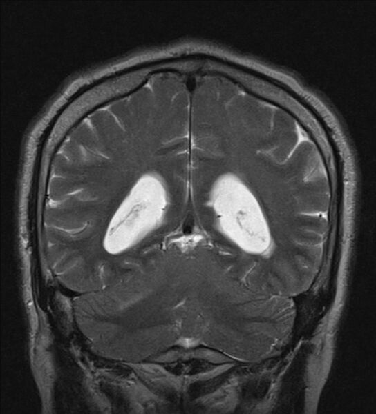 File:Cerebellopontine angle meningioma (Radiopaedia 24459-24764 Coronal T2 18).jpg