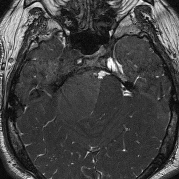 File:Cerebellopontine angle meningioma (Radiopaedia 24459-24764 I 28).jpg