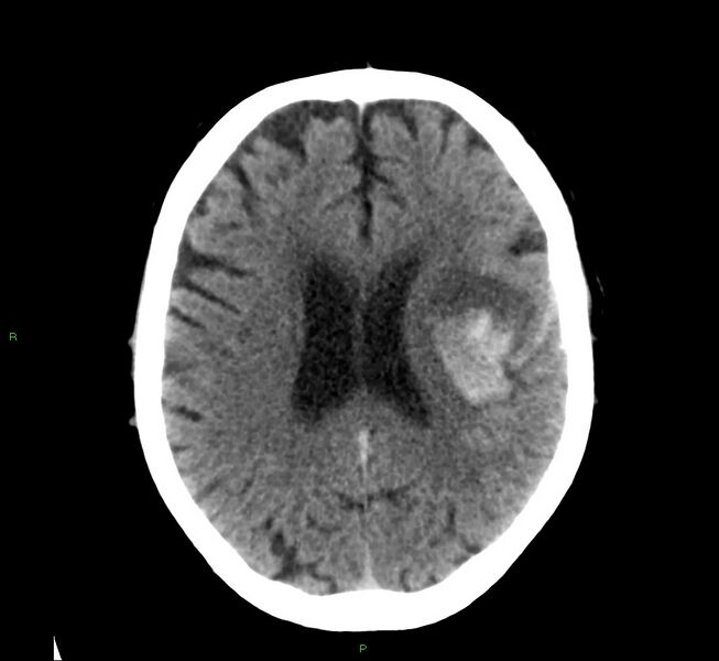 File:Cerebral amyloid angiopathy-associated lobar intracerebral hemorrhage (Radiopaedia 58376-65511 Axial non-contrast 23).jpg