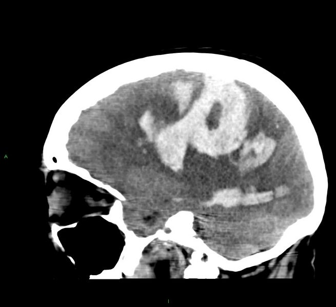 File:Cerebral amyloid angiopathy-associated lobar intracerebral hemorrhage (Radiopaedia 58379-65519 C 20).jpg