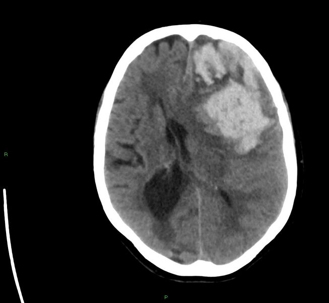 File:Cerebral amyloid angiopathy-associated lobar intracerebral hemorrhage (Radiopaedia 58561-65724 Axial non-contrast 21).jpg