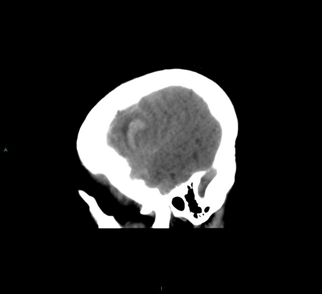 File:Cerebral amyloid angiopathy-associated lobar intracerebral hemorrhage (Radiopaedia 58561-65724 C 43).jpg