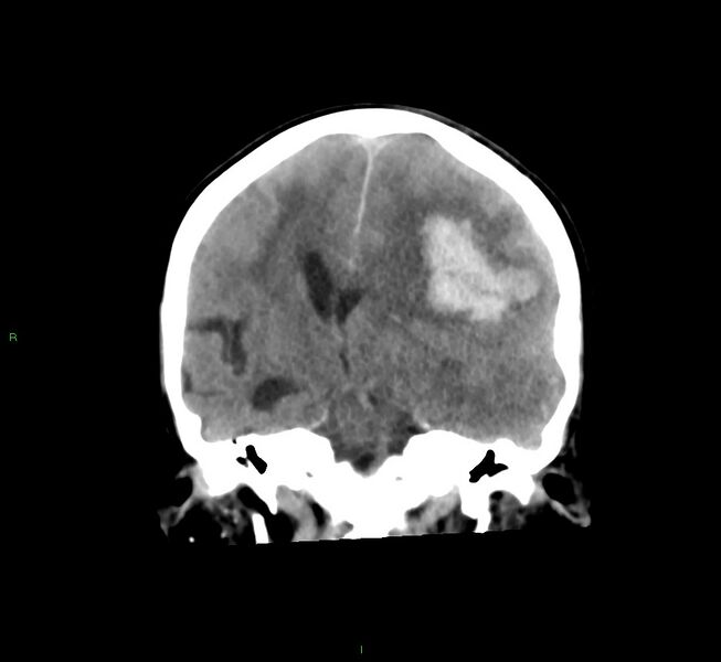 File:Cerebral amyloid angiopathy-associated lobar intracerebral hemorrhage (Radiopaedia 58561-65724 Coronal non-contrast 33).jpg