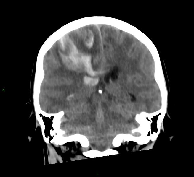 File:Cerebral amyloid angiopathy-associated lobar intracerebral hemorrhage (Radiopaedia 58566-65730 Coronal non-contrast 31).jpg