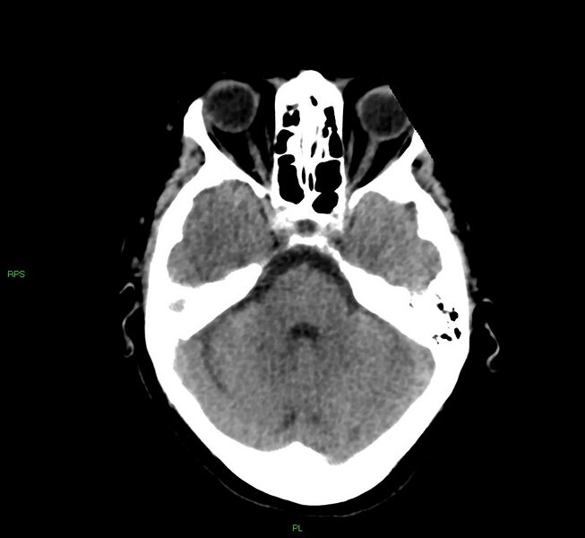 File:Cerebral amyloid angiopathy-associated lobar intracerebral hemorrhage (Radiopaedia 58569-65734 Axial non-contrast 43).jpg