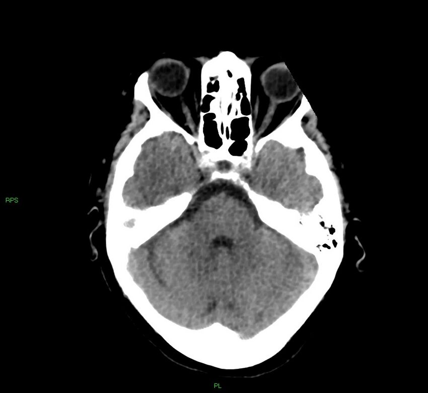 Cerebral amyloid angiopathy-associated lobar intracerebral hemorrhage (Radiopaedia 58569-65734 Axial non-contrast 43).jpg