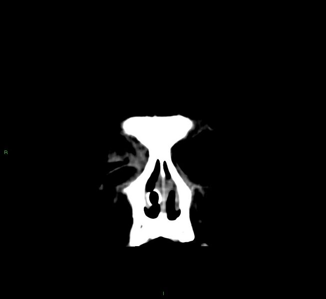 File:Cerebral amyloid angiopathy-associated lobar intracerebral hemorrhage (Radiopaedia 58751-65972 Coronal non-contrast 59).jpg