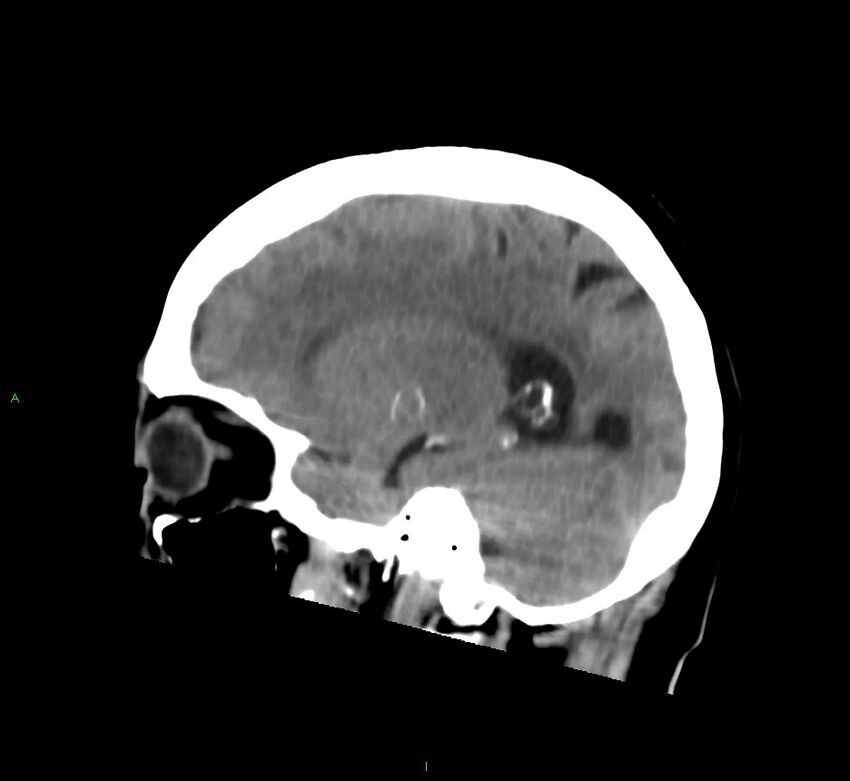 Cerebral amyloid angiopathy-associated lobar intracerebral hemorrhage (Radiopaedia 58752-65973 C 19).jpg