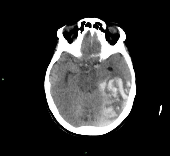 File:Cerebral amyloid angiopathy-associated lobar intracerebral hemorrhage (Radiopaedia 58754-65975 Axial non-contrast 40).jpg