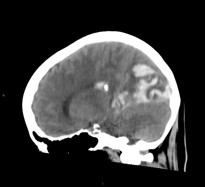File:Cerebral amyloid angiopathy-associated lobar intracerebral hemorrhage (Radiopaedia 58754-65975 C 28).jpg