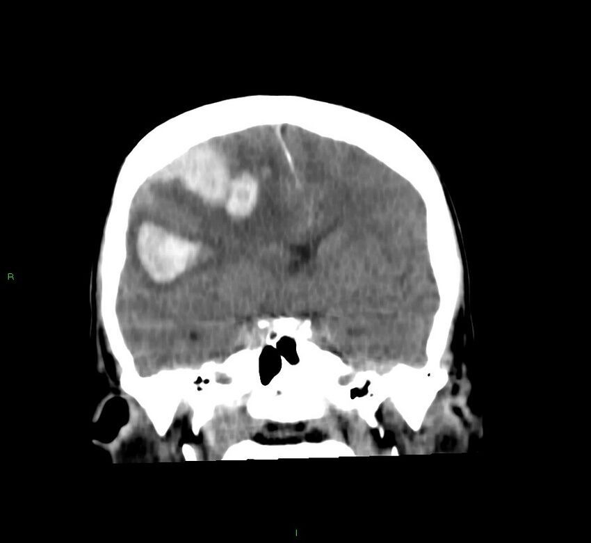 Cerebral amyloid angiopathy-associated lobar intracerebral hemorrhage (Radiopaedia 58756-65977 Coronal non-contrast 38).jpg