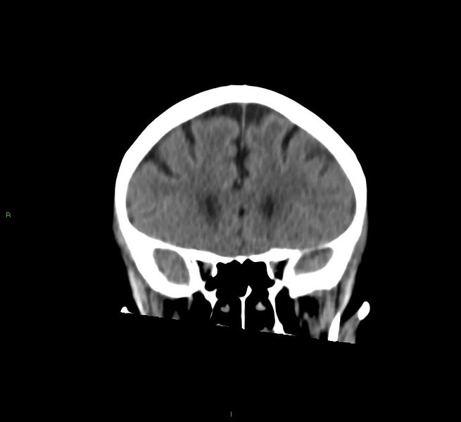 File:Cerebral amyloid angiopathy-associated lobar intracerebral hemorrhage (Radiopaedia 58757-65978 Coronal non-contrast 48).jpg