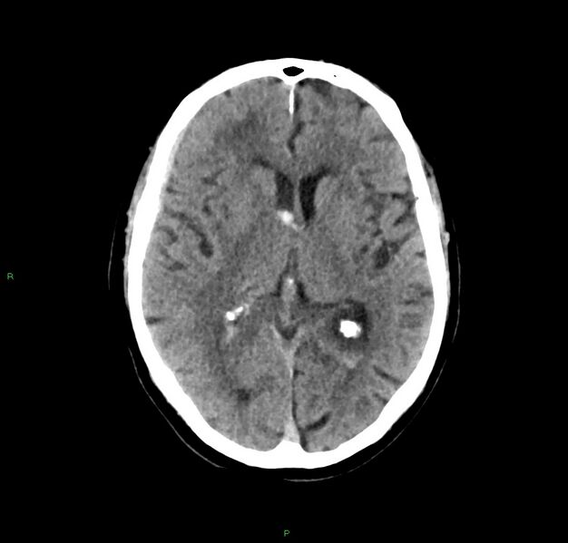 File:Cerebral amyloid angiopathy-associated lobar intracerebral hemorrhage (Radiopaedia 59356-66716 Axial non-contrast 24).jpg