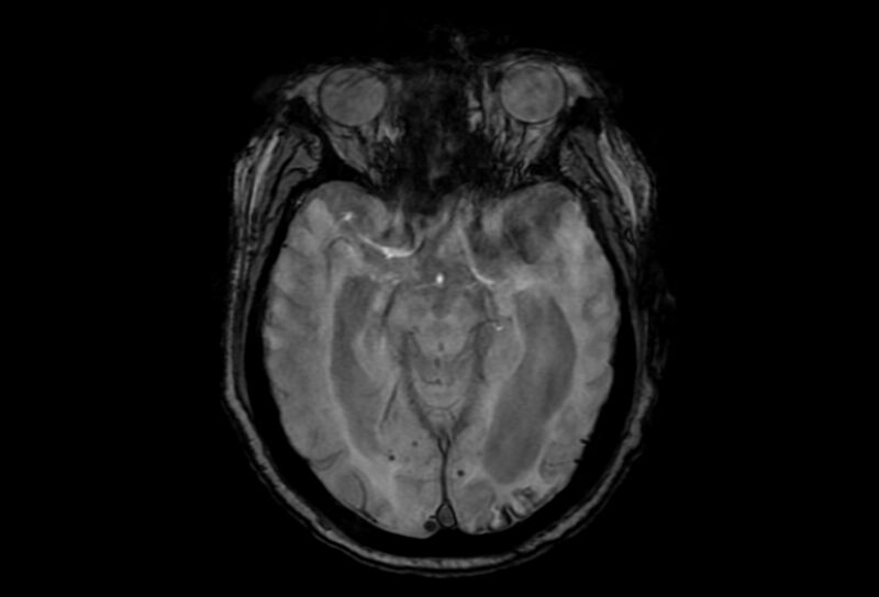File:Cerebral amyloid angiopathy (Radiopaedia 86671-102792 Axial Gradient Echo 35).jpg