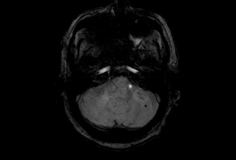 File:Cerebral amyloid angiopathy (Radiopaedia 86671-102792 Axial Gradient Echo 46).jpg