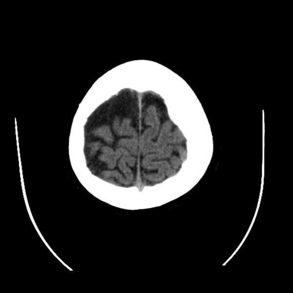 File:Cerebral arteriovenous malformation (Radiopaedia 43729-47189 Axial non-contrast 39).jpg