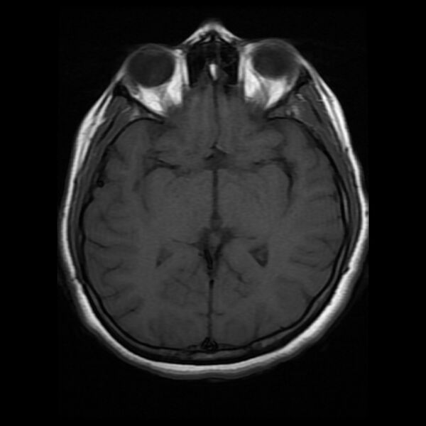 File:Cerebral cavernous malformation (Radiopaedia 44301-47942 Axial T1 10).jpg