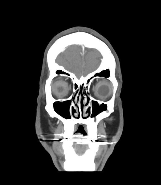 File:Cerebral dural venous sinus thrombosis (Radiopaedia 86514-102576 B 1).jpg