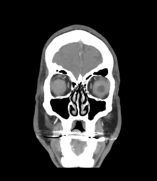 File:Cerebral dural venous sinus thrombosis (Radiopaedia 86514-102576 B 2).jpg