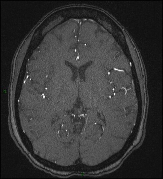 File:Cerebral fat embolism (Radiopaedia 35022-36525 Axial TOF 114).jpg