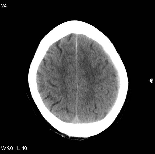 File:Cerebral hemorrhagic contusion with subdural and subarachnoid hemorrhage (Radiopaedia 10680-11146 Axial non-contrast 21).jpg