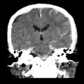 Cerebral hemorrhagic contusions (Radiopaedia 23145-23188 Coronal non-contrast 24).jpg