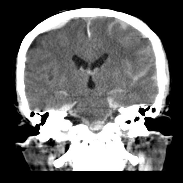 File:Cerebral hemorrhagic contusions (Radiopaedia 23145-23188 Coronal non-contrast 24).jpg