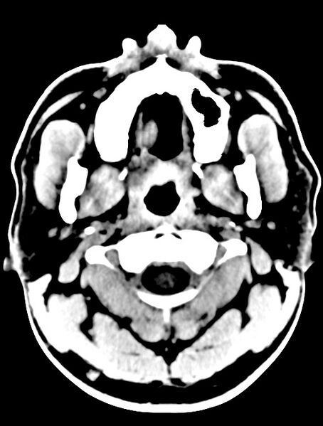 File:Cerebral venous angioma (Radiopaedia 69959-79977 Axial non-contrast 1).jpg