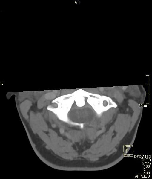 File:Cerebral venous sinus thrombosis (Radiopaedia 91329-108965 Axial venogram 3).jpg