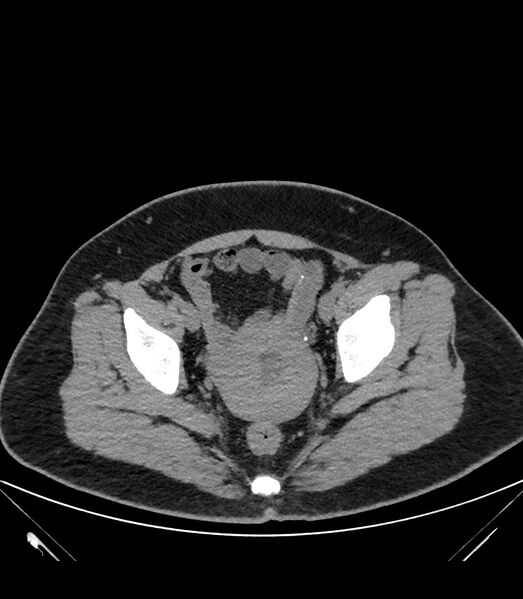 File:Cervical aortic arch with coarctation and aneurysms (Radiopaedia 44035-47552 Axial non-contrast 90).jpg