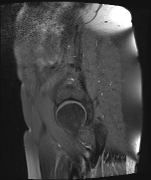 File:Cervical carcinoma (Radiopaedia 88312-104943 Sagittal T1 fat sat 2).jpg