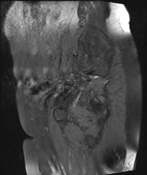 File:Cervical carcinoma (Radiopaedia 88312-104943 Sagittal T1 fat sat 7).jpg