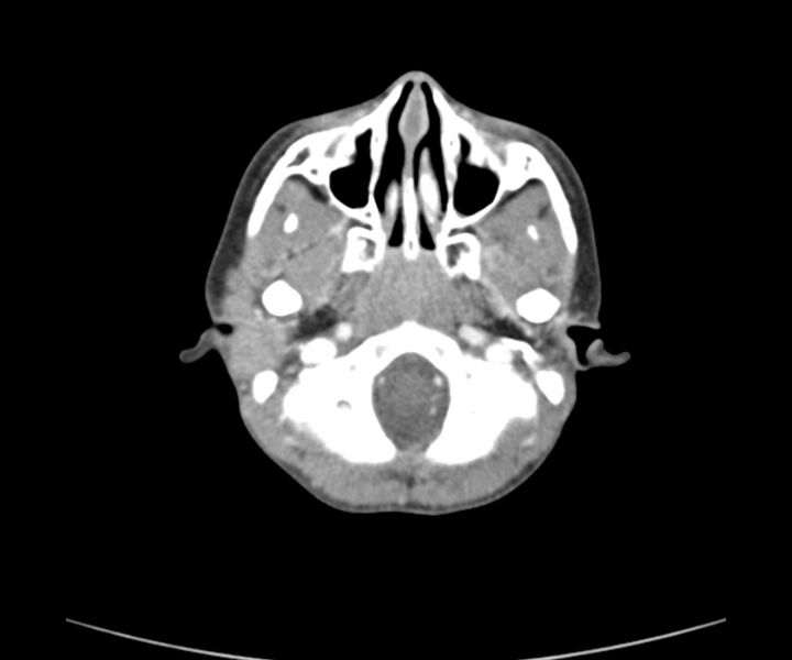 File:Cervical cystic lymphangioma (Radiopaedia 63655-72332 Axial + contrast 3).jpg