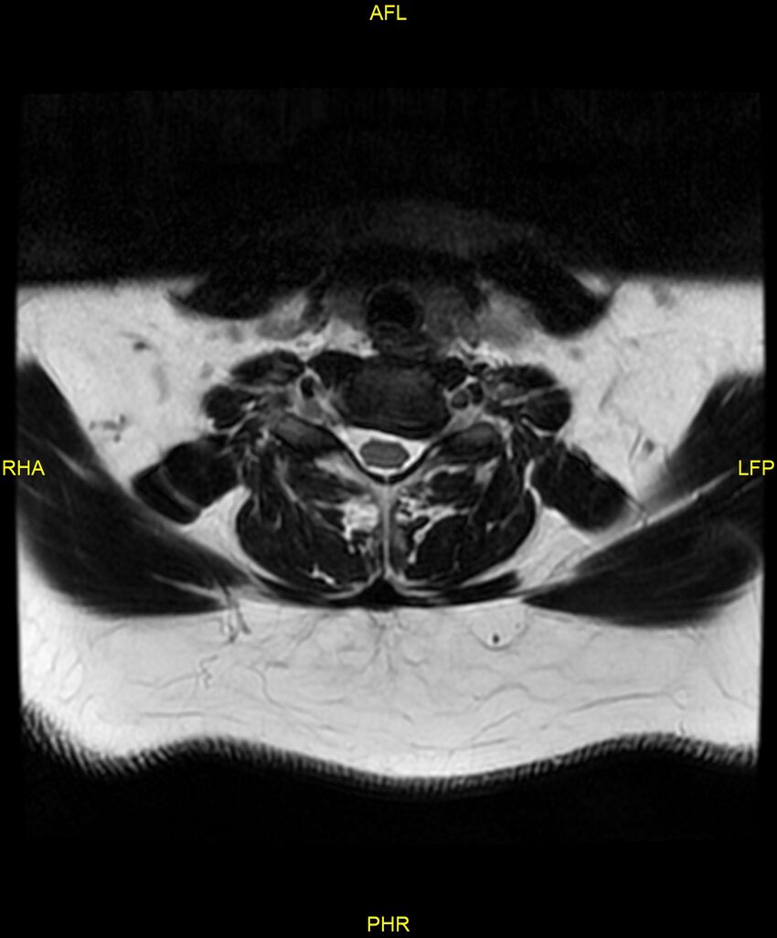 Cervical disc protrusion (Radiopaedia 87147-103415 Axial T2 51).jpg