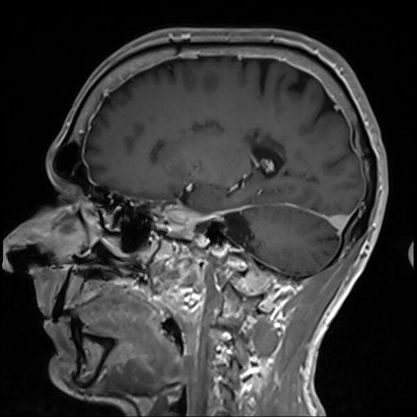 File:Cervical dural CSF leak on MRI and CT treated by blood patch (Radiopaedia 49748-54995 G 38).jpg