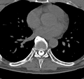 Cervical dural CSF leak on MRI and CT treated by blood patch (Radiopaedia 49748-54996 B 63).png