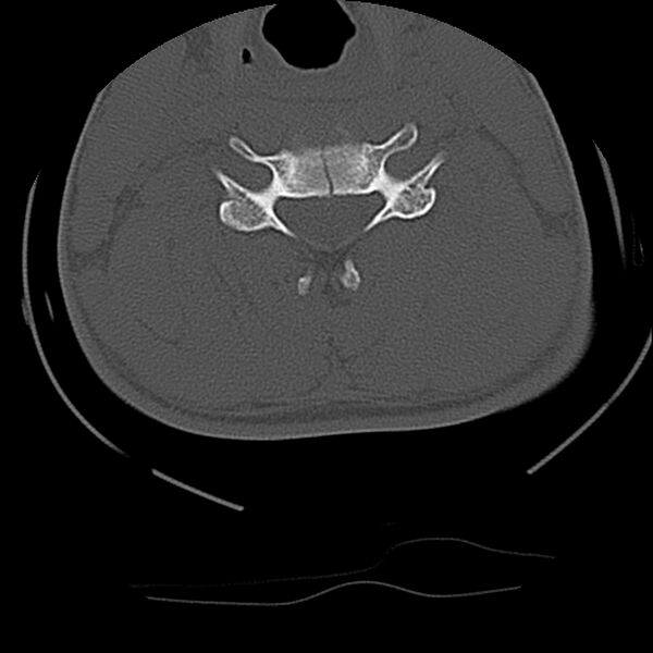 File:Cervical flexion teardrop fracture with cord hemorrhage (Radiopaedia 32497-33454 Axial bone window 49).jpg