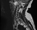 Cervical schwannoma (Radiopaedia 72399-82934 Sagittal T2 3).jpg