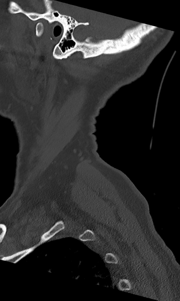 File:Cervical spine fracture - chalk stick (Radiopaedia 39116-41323 Sagittal bone window 3).png
