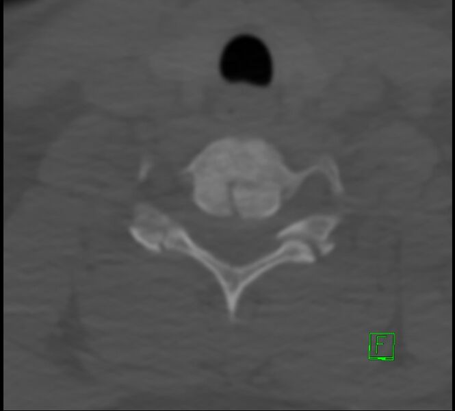 File:Cervical spine fracture - hyperflexion injury (Radiopaedia 66184-75364 Axial bone window 41).jpg