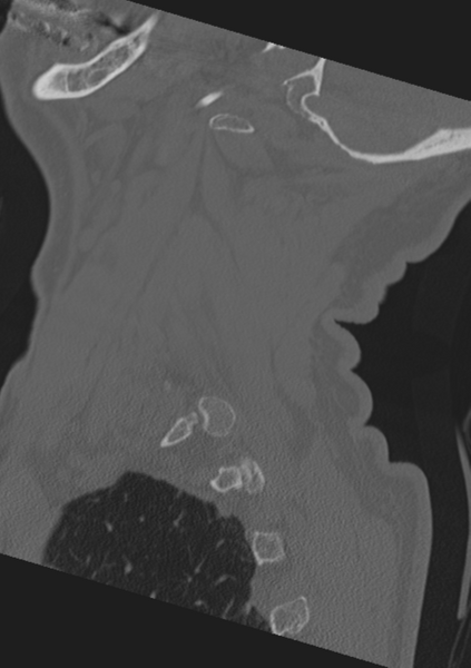 File:Cervical spine fractures with vertebral artery dissection (Radiopaedia 53296-59268 Sagittal bone window 9).png