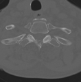 Cervical spondylolysis (Radiopaedia 49616-54811 Axial bone window 47).png