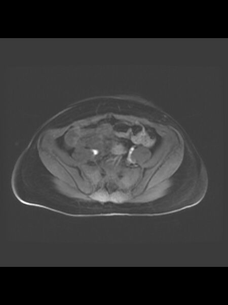 File:Cesarean section scar endometrioma (Radiopaedia 56569-63297 Axial T1 C+ fat sat 38).jpg