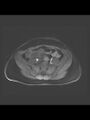 Cesarean section scar endometrioma (Radiopaedia 56569-63297 Axial T1 C+ fat sat 38).jpg