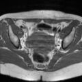 Cesarian section scar endometriosis (Radiopaedia 66520-75799 Axial T1 11).jpg