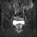 Cesarian section scar endometriosis (Radiopaedia 66520-75799 Coronal STIR 15).jpg
