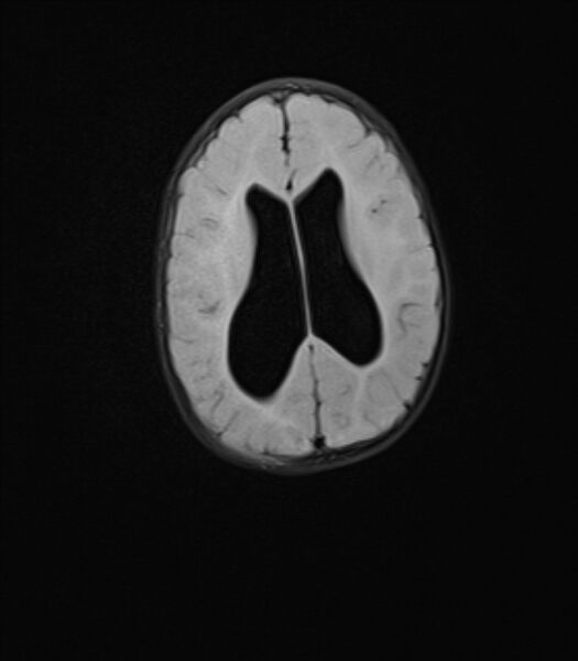 File:Chiari III malformation with occipital encephalocele (Radiopaedia 79446-92559 Axial FLAIR 18).jpg