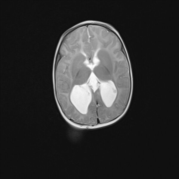 File:Chiari III malformation with occipital encephalocele (Radiopaedia 79446-92559 Axial T2 16).jpg